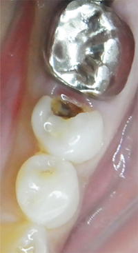 虫歯の確認 